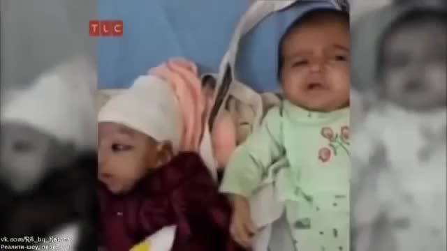  Жалалабадда эки баштуу бала төрөлүптүр