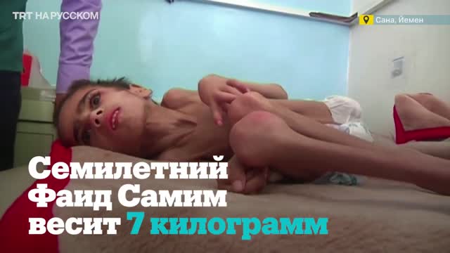 Йемендеги кризис. 7 жашында 7 килограмм гана салмакта болгон бала жардамга муктаж