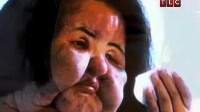 Пластикалык операциянын кесепети