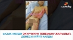  Ысык-Көлдө окуучунун телефону жарылып, денесинин 30 пайызы күйүп калды 